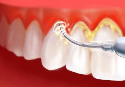 Alanyadental.net-Hizmetler-Diş Taşı tartar temizliği