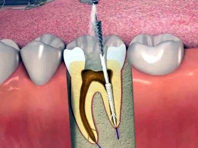 Alanyadental.net-Hizmetler-Kanal Tedavisi