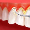 Alanyadental.net-Hizmetler-Diş Taşı tartar temizliği